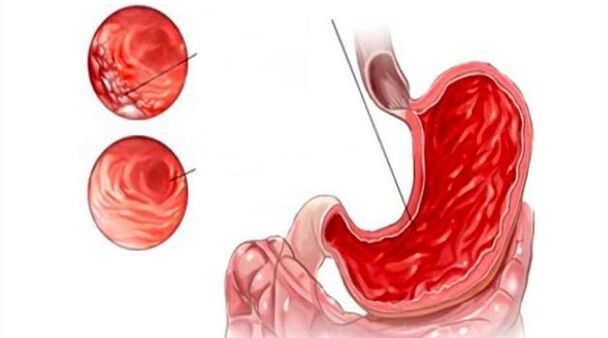 Damage to the gastric mucosa when taking alcohol