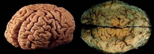 the brain of a healthy and drinking person